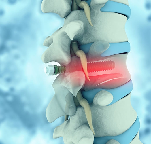 Medical implant manufacturing and control